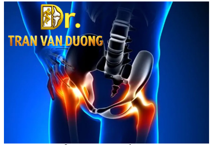 Hình minh họa Hoại Tử Vô Mạch Chỏm Xương Đùi – Bác sĩ CK2 Trần Văn Dương (TP.HCM)