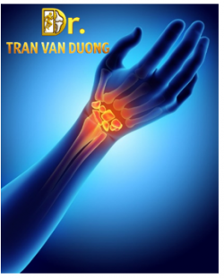 Hình minh họa Hội Chứng Ống Cổ Tay – Bác sĩ CK2 Trần Văn Dương (TP. HCM)