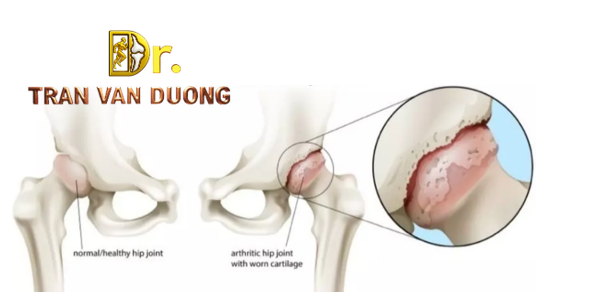 Lớp sụn ở khớp háng bị mòn trong Thoái Hóa Khớp Háng - Bác sĩ CKII Trần Văn Dương (TP. HCM)