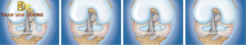 Các loại rách sụn chêm thường gặp – Bác sĩ Trần Văn Dương (TP.HCM)