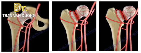Hình minh họa xương bị sụp đổ trong Hoại Tử Vô Mạch Chỏm Xương Đùi – Bác sĩ Trần Văn Dương (TP.HCM)