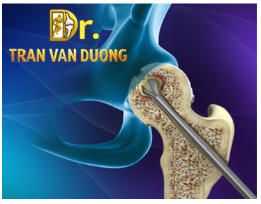 Hình minh họa Phẫu thuật khoan giảm áp điều trị Hoại Tử Vô Mạch Chỏm Xương Đùi – Bác sĩ Trần Văn Dương (TP.HCM)