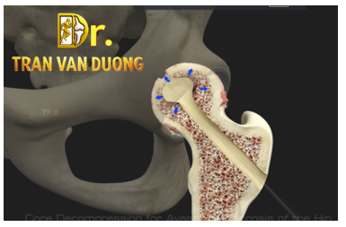 Phẫu thuật khoan giảm áp Hoại Tử Vô Mạch Chỏm Xương Đùi làm chậm nhu cầu Thay Khớp Háng – Bác sĩ Trần Văn Dương (TP.HCM)