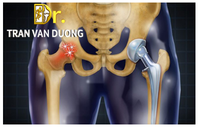 Thay khớp háng toàn phần là phẫu thuật hiệu quả điều trị hoại tử chỏm xương đùi – Bác sĩ Trần Văn Dương (TP.HCM)