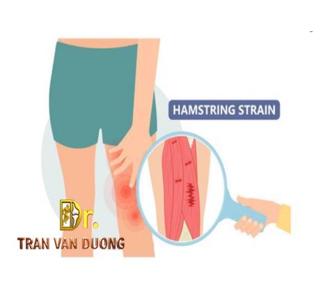 Hình minh họa vị trí đau trong Chấn Thương Cơ Gân Kheo - Bác sĩ CKII Trần Văn Dương (TP. HCM)