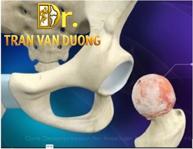 HOẠI TỬ VÔ MẠCH CHỎM XƯƠNG ĐÙI | BS Trần Văn Dương (TP.HCM)