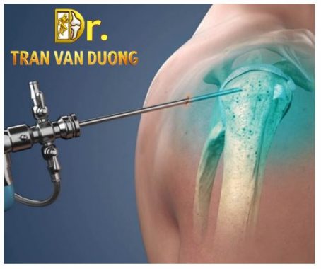 Shoulder-Arthroscopy