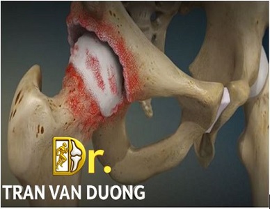 Xương và lớp sụn khớp bị mòn trong Thoái Hóa Khớp Háng – Bác sĩ CK2 Trần Văn Dương (TP. HCM)